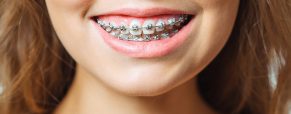 The most popular adult braces options
