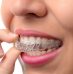 Will Invisalign Straighten Your Teeth?