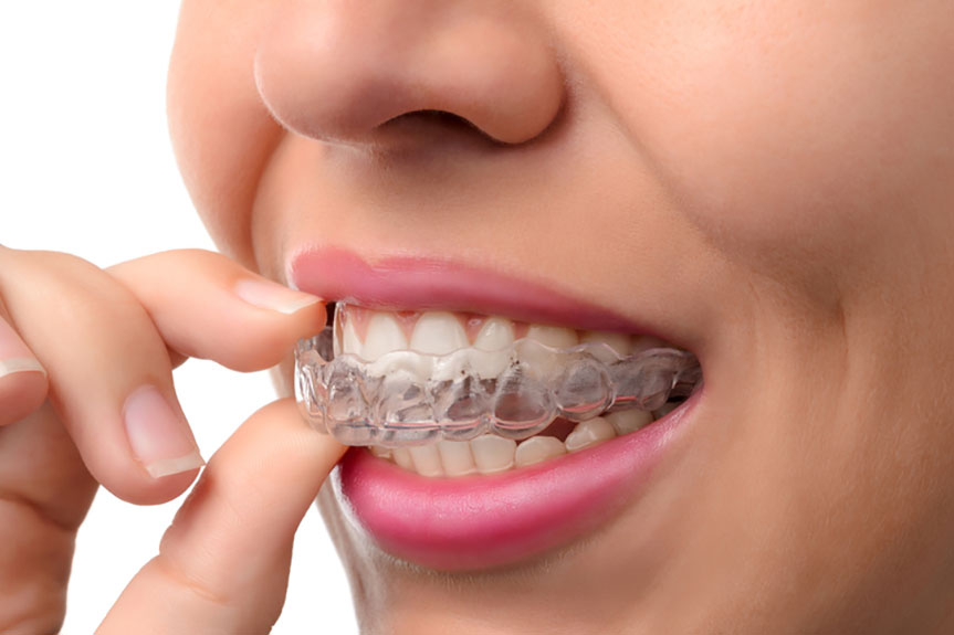 Will Invisalign Straighten Your Teeth?