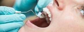 How dental veneers can improve your smile