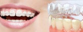 The Orthodontic Dilemma: Invisalign vs. Traditional Braces