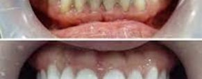 The Affordable Smile Makeover: Exploring the Cost of Veneers in Colombia